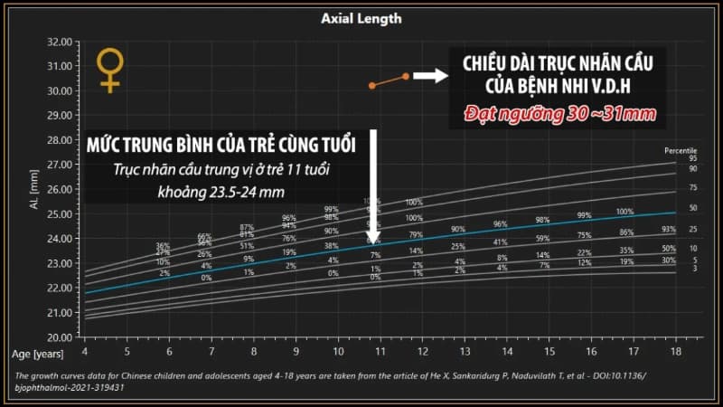 CẢNH BÁO NGUY CƠ BIẾN CHỨNG VÕNG MẠC Ở TRẺ CẬN THỊ NẶNG