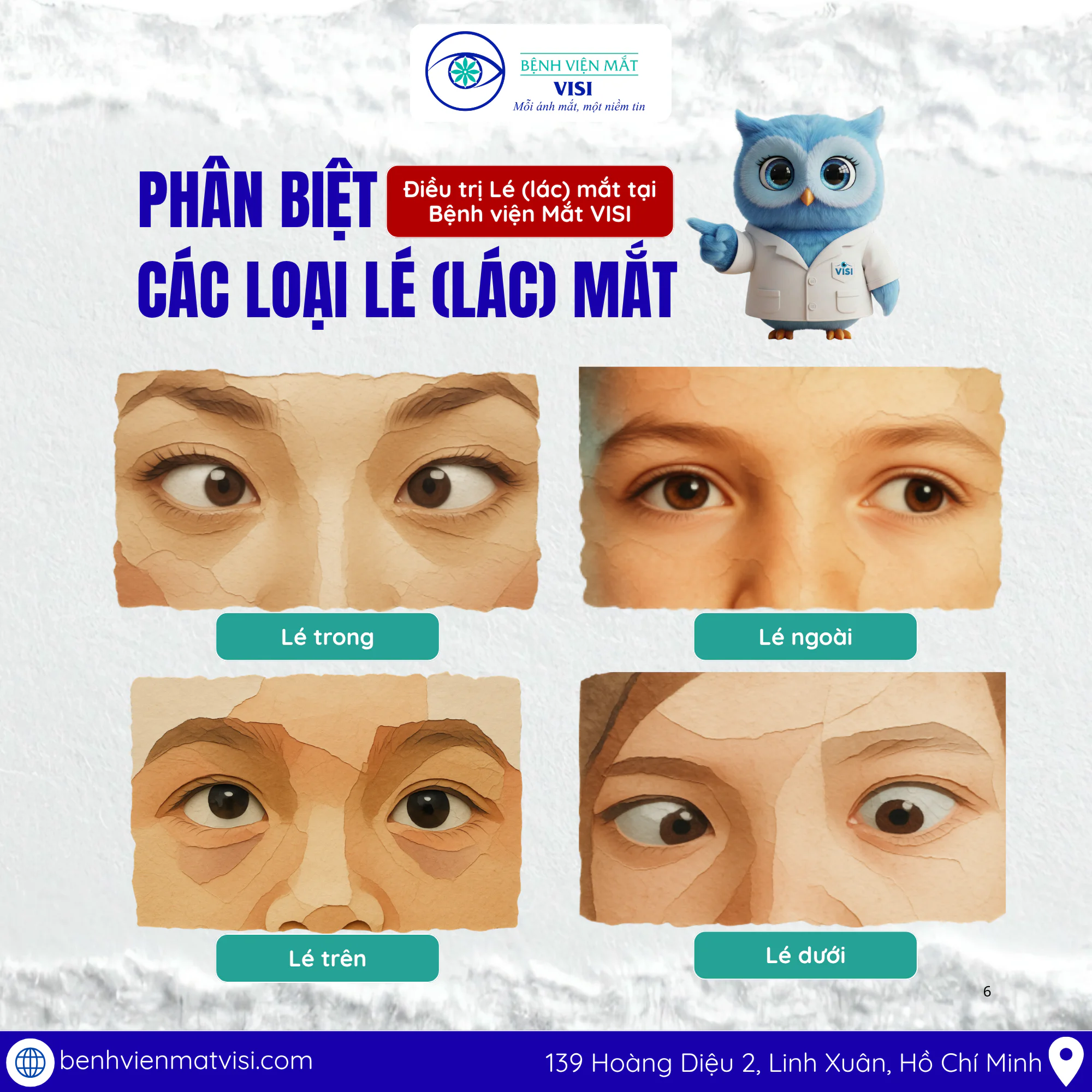 Một đôi mắt mất cân đối thường mang lại nhiều trở ngại tâm lý và sự tự ti trong giao tiếp. Tuy nhiên, lé (lác) hoàn toàn có thể được khắc phục an toàn và nhẹ nhàng nếu chúng ta hiểu đúng về bệnh lý này. Cùng Bệnh viện Mắt VISI tìm hiểu tổng quan về lác/lé nhé!