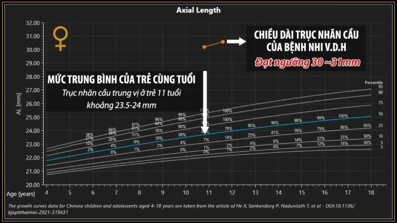 1780017239789-benh-nhi-11-tuoi-a-can-14-o-oi-mat-nguy-co-bien-chung-vong-mac-nghiem-trong-4568-1ce68699.webp