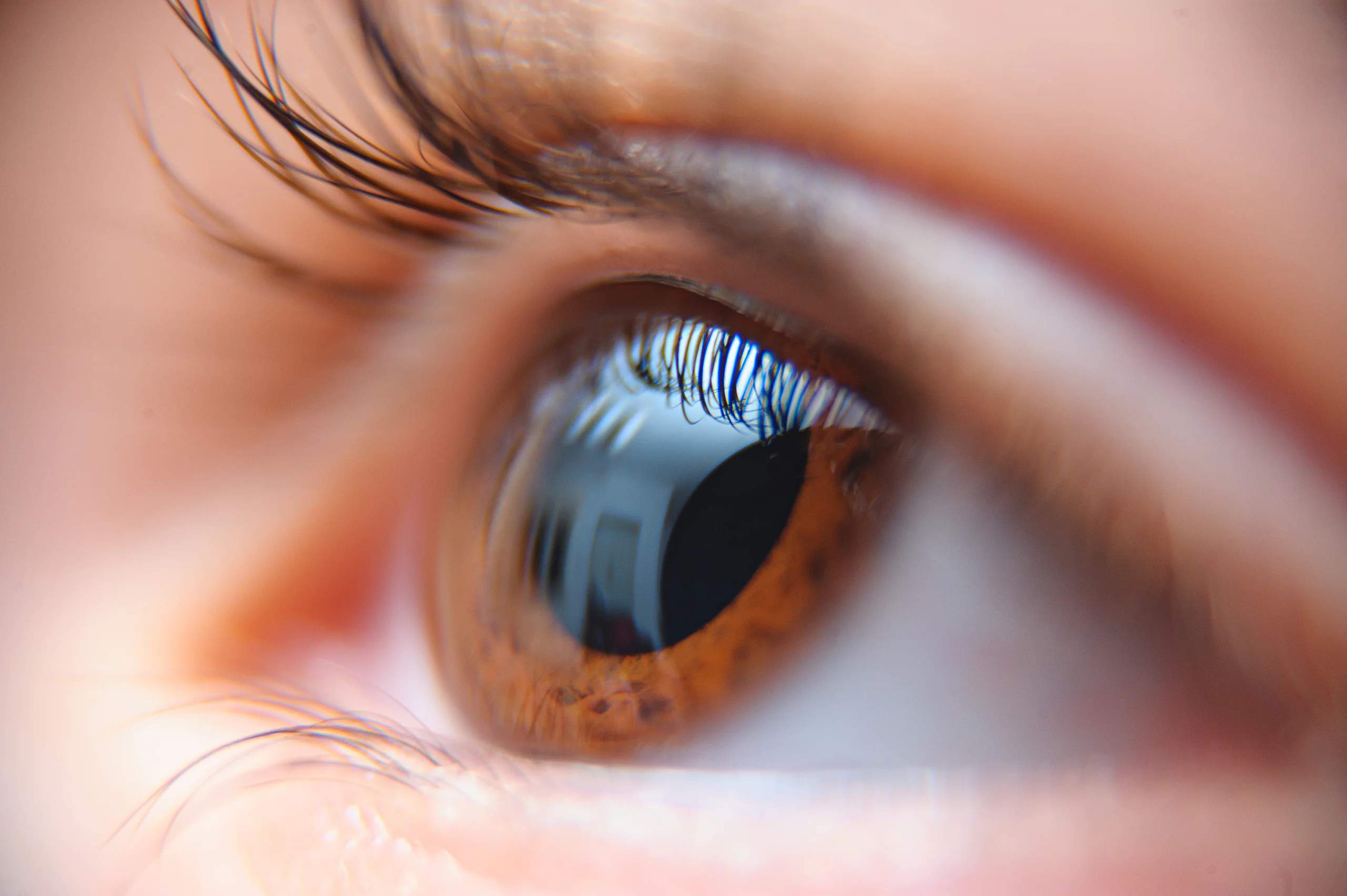 Corneal Collagen Cross-linking (viết tắt là CXL) là một thủ thuật nhãn khoa xâm lấn tối thiểu, sử dụng kết hợp chất cảm quang Riboflavin (Vitamin B2) và tia cực tím UV-A để gia tăng độ cứng và sức bền cơ sinh học của giác mạc.  Trong nhãn khoa hiện đại, phương pháp Cross-linking được ứng dụng cho hai mục đích chính:  Điều trị bệnh lý: Là phương pháp tiêu chuẩn để điều trị bệnh giác mạc hình chóp (Keratoconus) hoặc chứng giãn giác mạc, giúp ngăn chặn sự tiến triển của bệnh.  Kết hợp trong phẫu thuật khúc xạ (Mổ cận): Được thực hiện đồng thời hoặc ngay sau các ca mổ laser (như FEMTO LASIK, SMILE) như một thủ thuật bổ trợ nhằm gia cố sự vững chắc cho giác mạc.