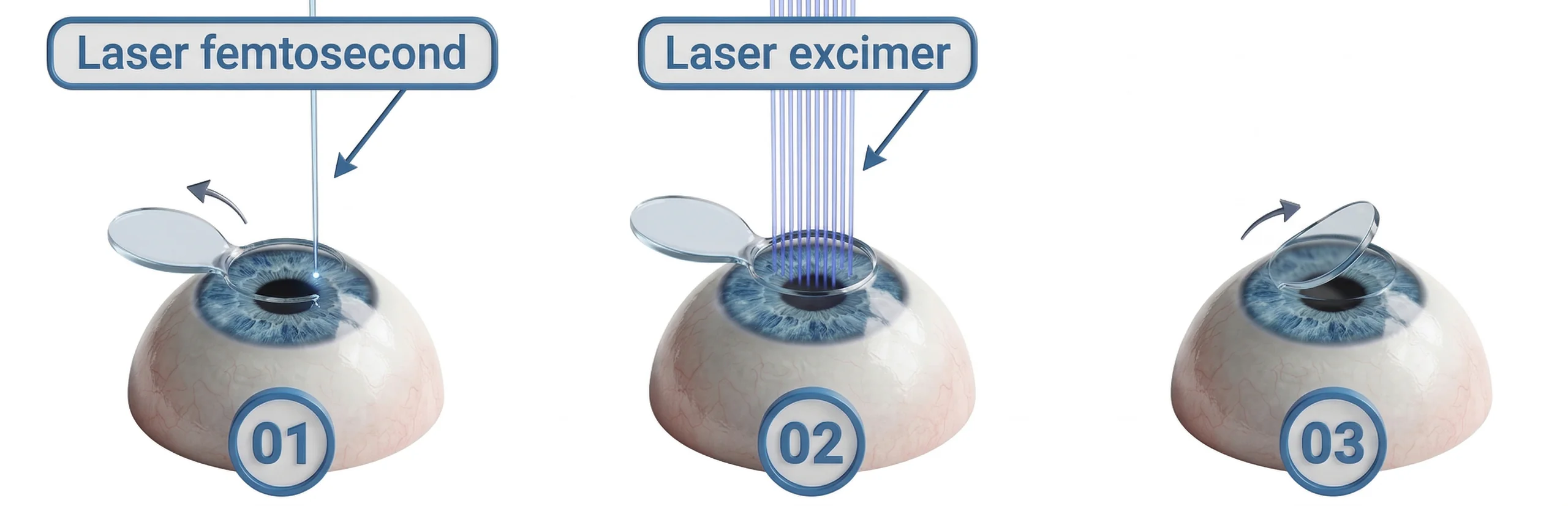 Mổ cận FemtoLASIK phương pháp phẫu thuật sử dụng 100% tia laser (Femtosecond Laser để tạo vạt và Excimer Laser để chỉnh độ) thay cho dao cơ học truyền thống.