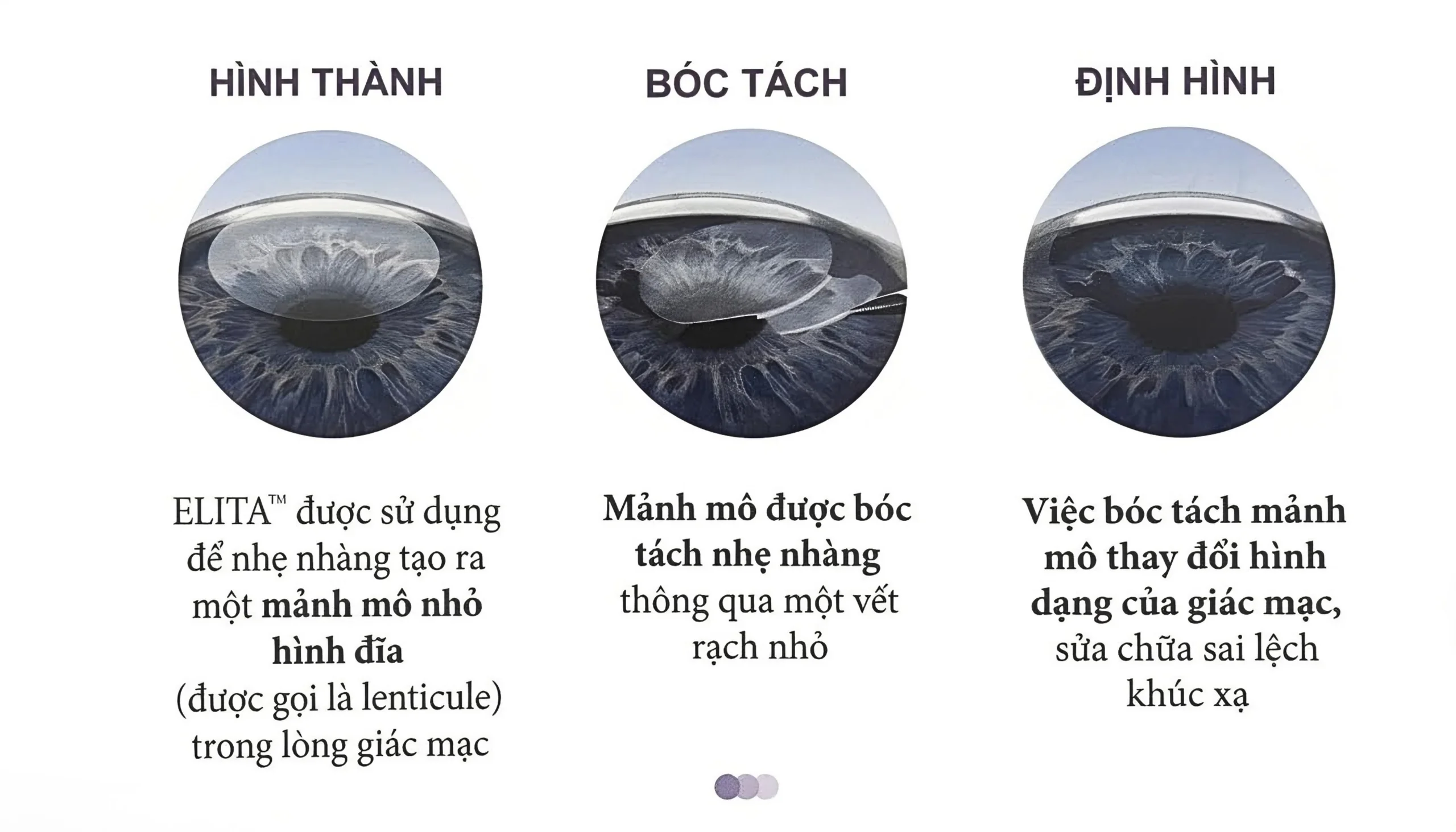 Quá trình phẫu thuật SILK diễn ra cực kỳ nhanh chóng và êm ái, chỉ mất khoảng 15 phút cho toàn bộ ca phẫu thuật. Quy trình cơ bản gồm các bước sau:  Bước 1: Chiếu Laser tạo lõi nhu mô: Bác sĩ sử dụng hệ thống ELITA chiếu tia laser Femtosecond xuyên qua bề mặt giác mạc. Với tốc độ siêu nhanh (10 MHz) và năng lượng cực thấp, tia laser sẽ định hình một lõi nhu mô có dạng hai mặt lồi (Biconvex) bên trong giác mạc. Thời gian chiếu laser siêu tốc, chỉ mất khoảng 16 giây cho mỗi mắt.  Bước 2: Tạo đường rạch siêu nhỏ: Máy laser đồng thời tạo một đường rạch vết mổ cực nhỏ, chỉ từ 2mm - 3mm ở rìa giác mạc.  Bước 3: Rút lõi nhu mô: Bác sĩ nhẹ nhàng dùng dụng cụ chuyên dụng qua vết rạch nhỏ để rút lõi nhu mô ra ngoài, làm thay đổi độ cong giác mạc để triệt tiêu hoàn toàn độ cận, loạn thị. Nhờ bề mặt cắt cực kỳ láng mịn, 91% các ca mổ SILK không cần dùng lực bóc tách mô cơ học