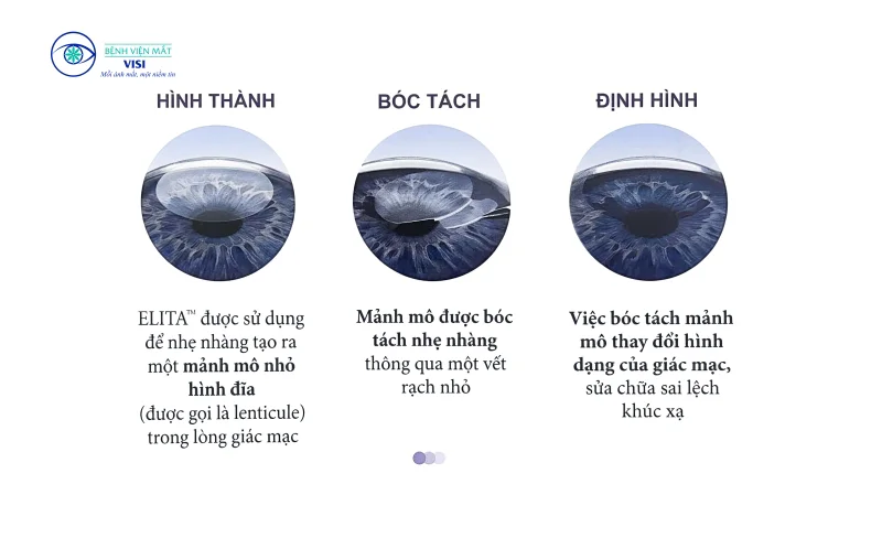 phương pháp mổ cận thị SILK bệnh viện VISI Thủ Đức Hồ Chí Minh