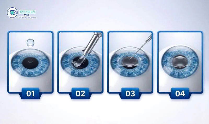 Mổ cận thị PHAKIC bệnh viện mắt visi hồ chí minh